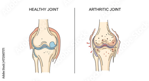 Illustration comparing a healthy knee joint, smooth and intact, with an arthritic joint showing damage, inflammation, and bone spurs. Labels identify each type.