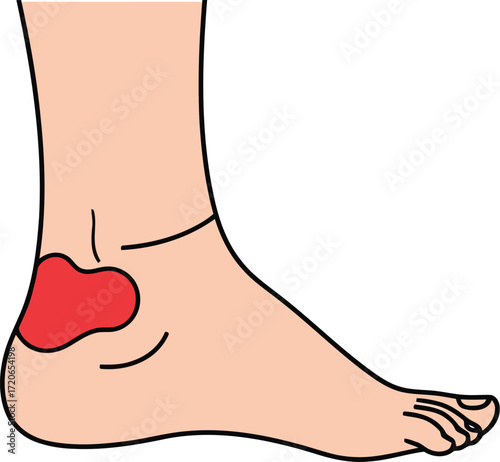 Illustration of heel pain inflammation medical diagram showing discomfort and injury in the foot's plantar fascia area vector