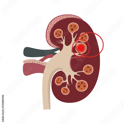 Visual of a kidney with a tumor highlighted, perfect for medical education materials or health awareness campaigns to teach about kidney health and cancer risks