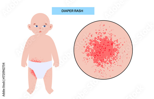 Diaper rash poster
