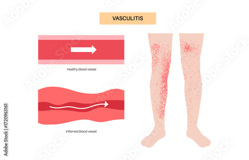 Vasculitis medical poster