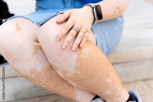 Woman showing lower body with vitiligo skin condition