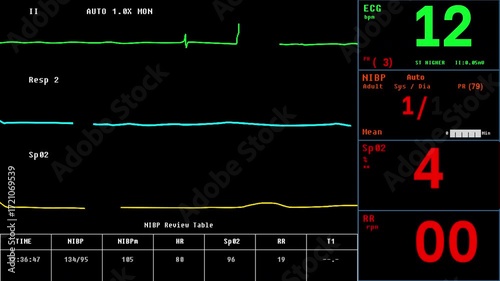 Heartbeat Monitoring Device Interface Shows Stabilizing Condition Of Patient. Heartbeat Monitoring Interface Detects Recovery Of Patient. Patients Heartbeat Improvement. ECG Monitoring Interface