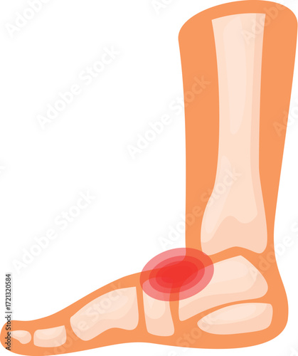 Medical illustration showing foot bones with red spot indicating pain, injury, or disease