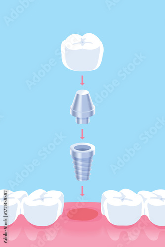 Step of Dental Implant illustration vector design. Dental care concept.