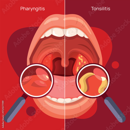 Detailed Illustrations of Pharyngitis and Tonsillitis