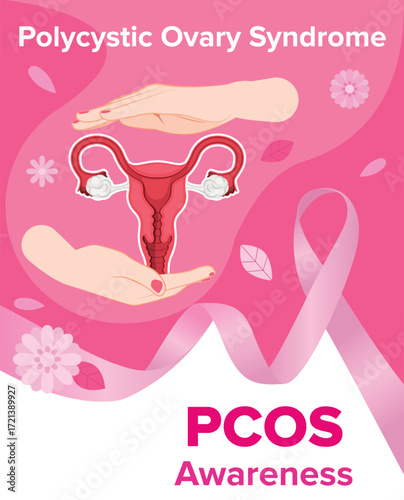 Polycystic Ovary Syndrome, PCOS awareness month, Medical illustration
