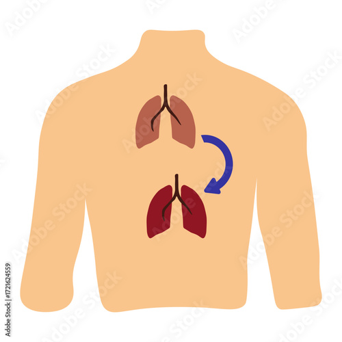 Lung Transplant