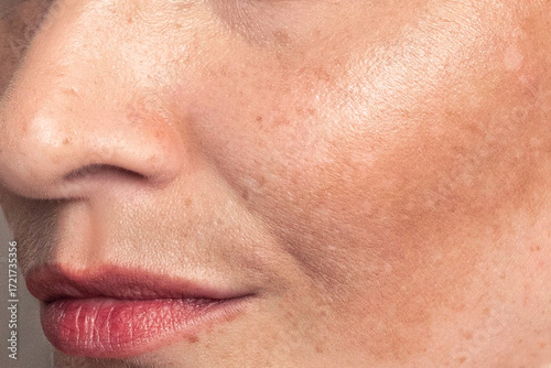Cropped close up photo Woman with pigmentation, melasma, freckles, age spots photo. Texture
