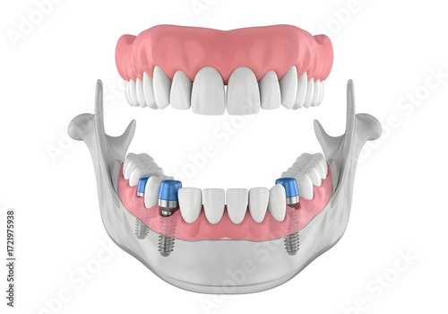 Anatomical model showcasing dental implants and dentures set within a jawbone structure viewable