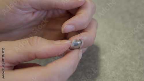 This video shows a hand picking at a rotten, injured, and bruised nail that is coming off of a finger. 