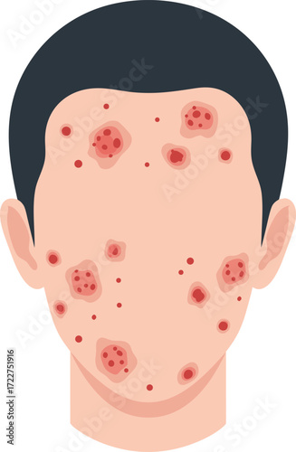 A medical illustration showing a person with multiple red pustules and lesions on the face, indicating a secondary infection related to severe acne