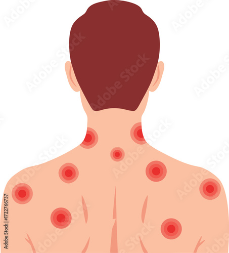 An illustration of a person with red welts on the back, indicating the characteristic rash of shingles (herpes zoster) infection