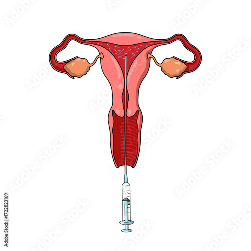 Illustration of Intrauterine Insemination, IUI treatment, Sperm Donor, pregnancy planning, egg and sperm cells, vector illustration for medical posters, clinics, and education
