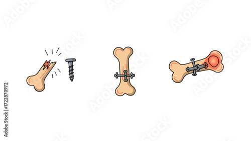 Advanced Bone Fracture Healing Process with Surgical Fixation and Recovery Stages - Comprehensive Orthopedic Illustration