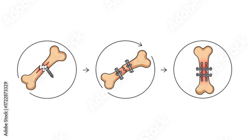 Advanced Bone Fracture Healing Process with Surgical Fixation and Recovery Stages - Comprehensive Orthopedic Illustration