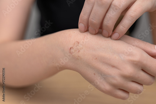 A woman scratches her hand, her dry skin covered in peeling scabs caused by allergies.