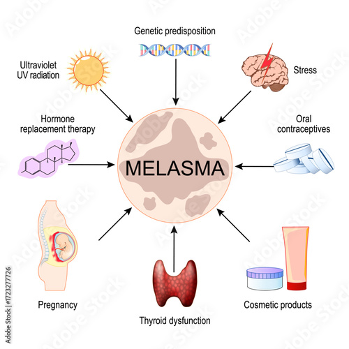 Melasma Triggers. Chloasma faciei. Mask of pregnancy.