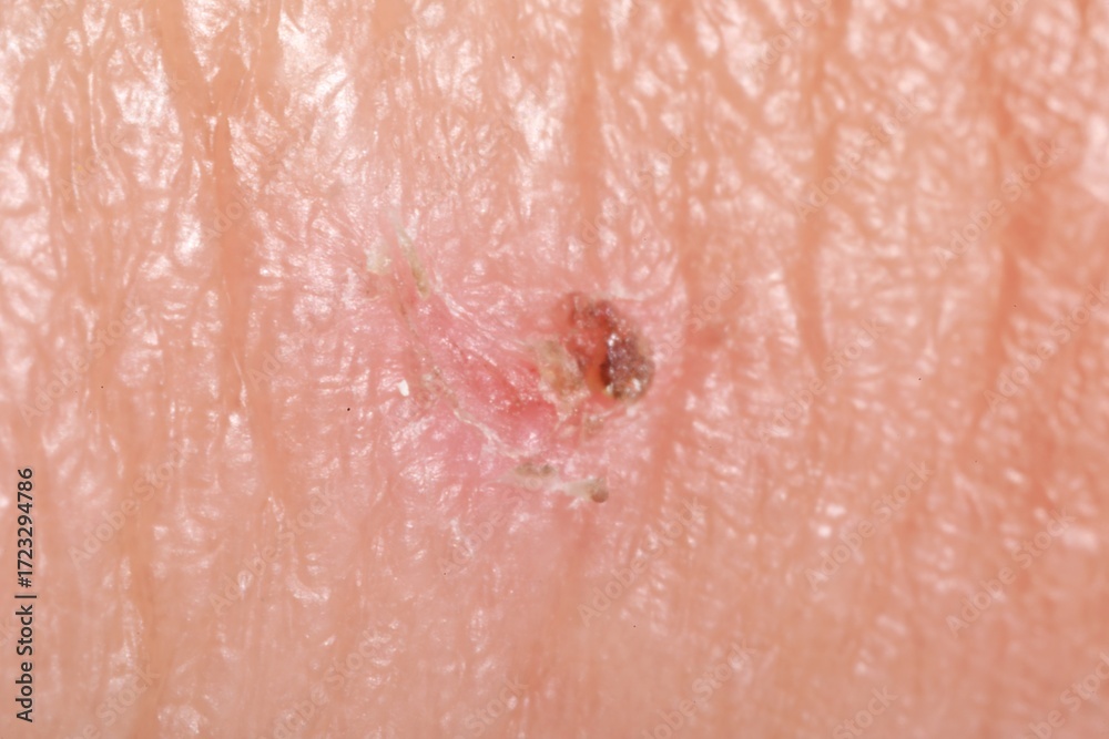 Fototapeta premium Macro view of damaged human skin as background