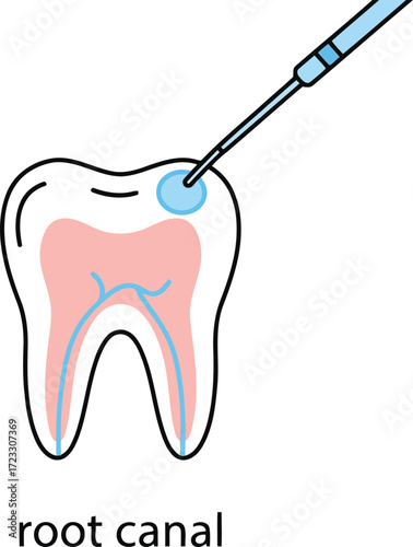 Root canal procedure dental illustration vector