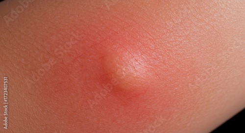 Skin Abscess with Inflammation and Redness Close Up