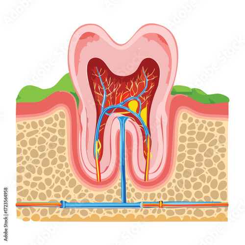 Cross-section illustration of a molar tooth with decay near the gumline, showing the cavity and the beginning of infection spreading toward the pulp	