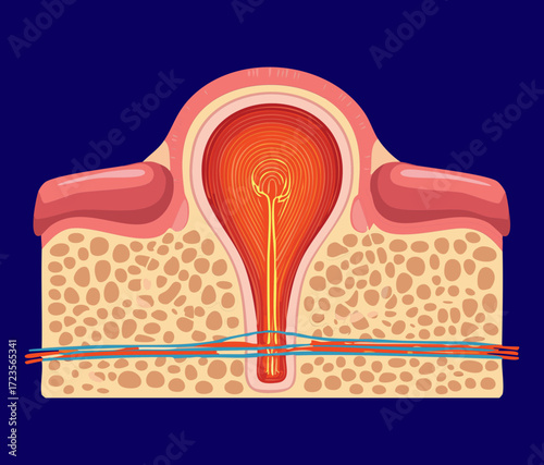 A large periapical abscess illustration, showing a severe infection at the root apex of a tooth with pus formation and bone destruction against a dark background	