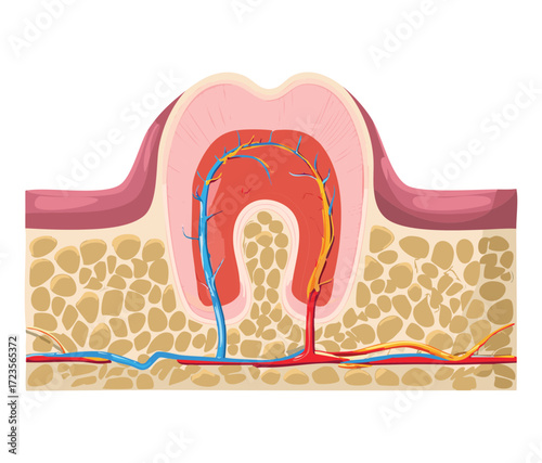 Detailed cross-section of a molar tooth with deep decay, showing caries progression into the pulp and the vascular and nerve supply in the root canal	