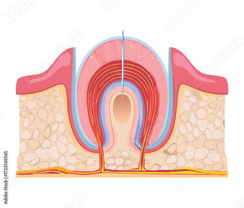 Cross-section illustration of a single tooth with periodontal disease, showing inflammation in the gum and bone loss around the tooth root	