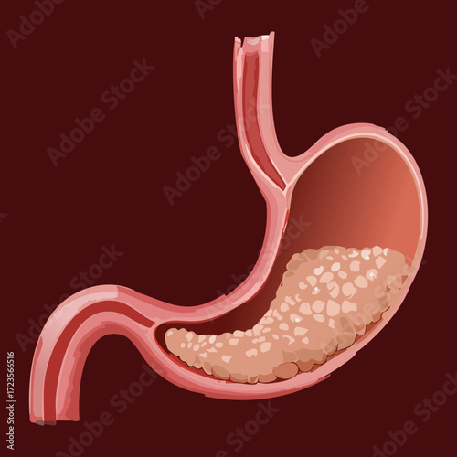 Cutaway view of the stomach filled with partially digested food, emphasizing the mucosal lining and glandular secretions	