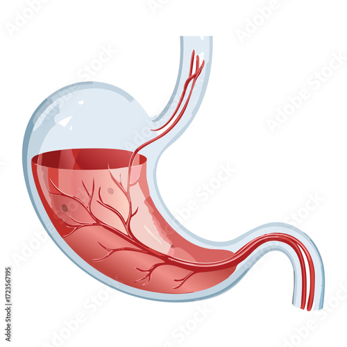 Diagram of the Human Stomach Filling with Red Fluid Representing Acid Reflux Gastritis or Internal Bleeding Issues	