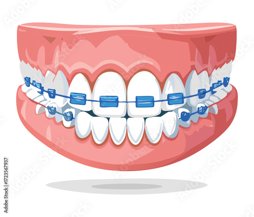 Close-up view of the upper and lower teeth with colorful orthodontic braces, representing dental correction and therapy	