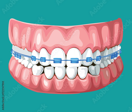 Anatomical illustration of the lower jaw and gums fitted with clear orthodontic aligners or braces, showing alignment therapy	