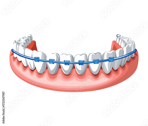 Human teeth model showing a removable wire retainer, representing orthodontic treatment for maintaining dental alignment	