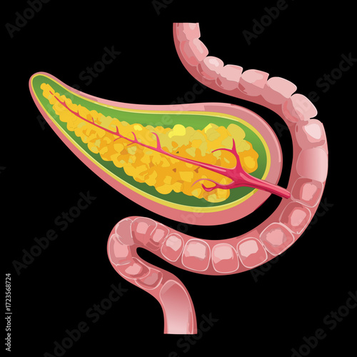Pancreas with Tumor Growth Concept Highlighting the Organ's Location Next to Duodenal Loop	