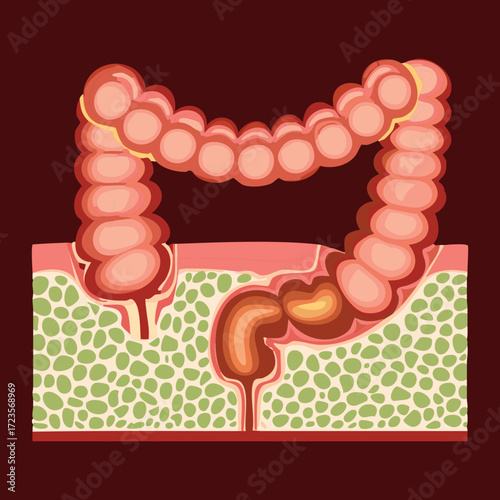 Full View of the Human Colon and Small Intestine with Mesentery Tissue and Vascular Network	