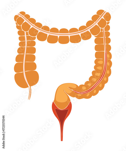 Comparative medical graphic contrasting the smooth, healthy lining of a normal colon with the severely inflamed and damaged tissue found in Inflammatory Bowel Disease