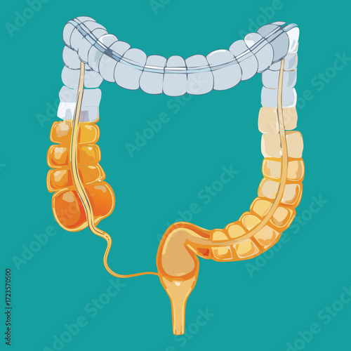 Clinical illustration showing the dangerous growth stages of a malignant tumor or advanced polyp inside the colon wall representing colorectal cancer progression