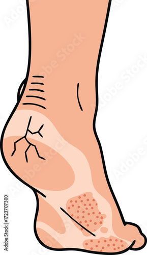Illustration of a human heel with visible cracks and dry, rough skin, highlighting common foot health issues and skin disorders