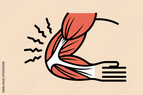 Illustration of arm muscle strain and pain with radiating discomfort