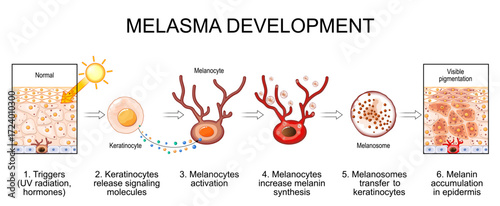 Melasma development. Melanocytes and Visible pigmentation in human skin
