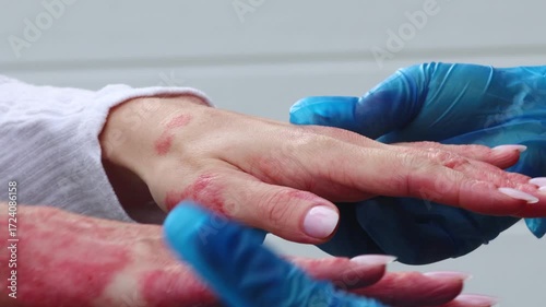 Skin problems treatment for eczema and dermatitis on hand at dermatology clinic