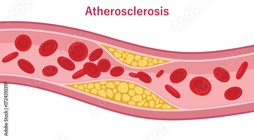 Atherosclerosis. Buildup of plaque in the walls of artery. Arteriosclerotic vascular disease. Medical illustration. 