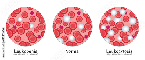 Leukocytosis and Leukopenia. High white blood cell count and low white blood cell count. White blood cell disorders. Medical illustration.