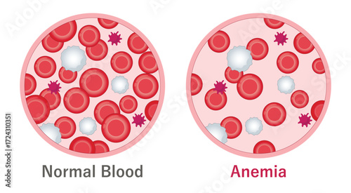 Normal blood and anemia. Low amount of red blood cells. Medical illustration. 