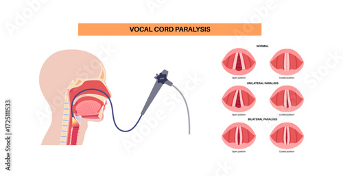 Vocal cords paralysis
