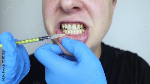 Dental injection for gum recession treatment. Exposure of tooth root and gum treatment. Regenerative therapy