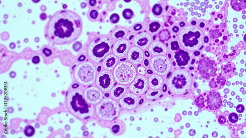 Micrograph of epithelial ovarian cancer cells, showing their characteristic pathological features. 