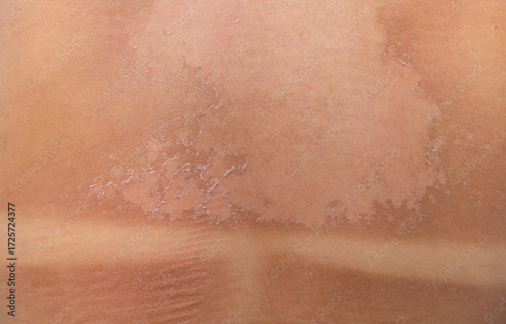 Fototapeta premium The back is sunburned and peeling. Selective focus.