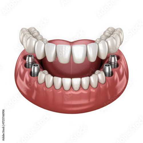  Dental implants supporting a full set of upper and lower artificial teeth isolated on transparent background